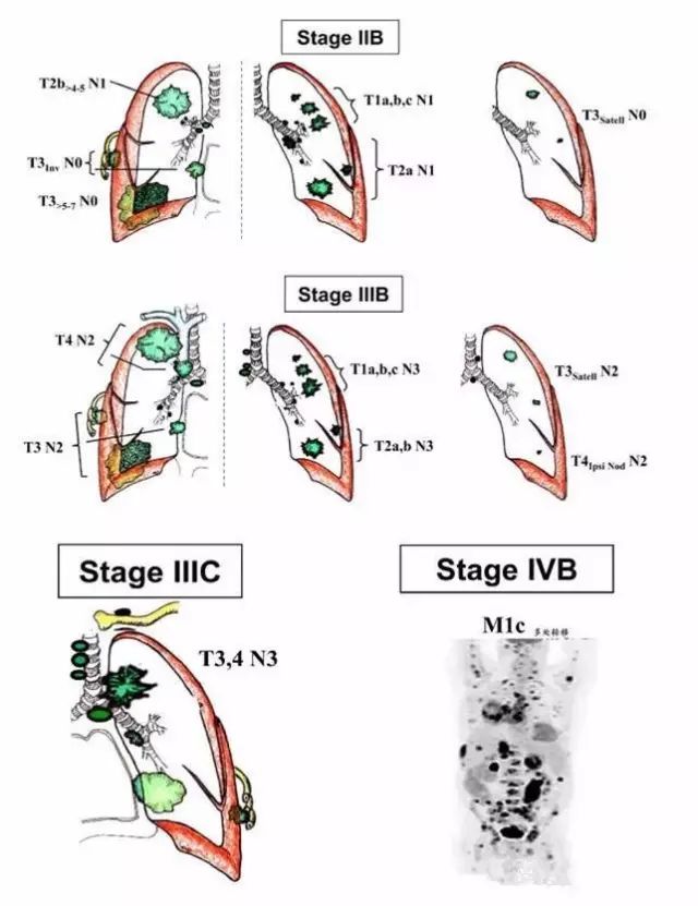 乳腺癌tnm分期标准图_tanner分期标准图_tnm分期标准图